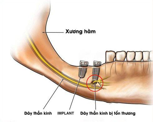 implant1