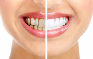 Cách Cải Thiện Nụ Cười xinh