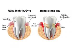 Bệnh Nha Chu